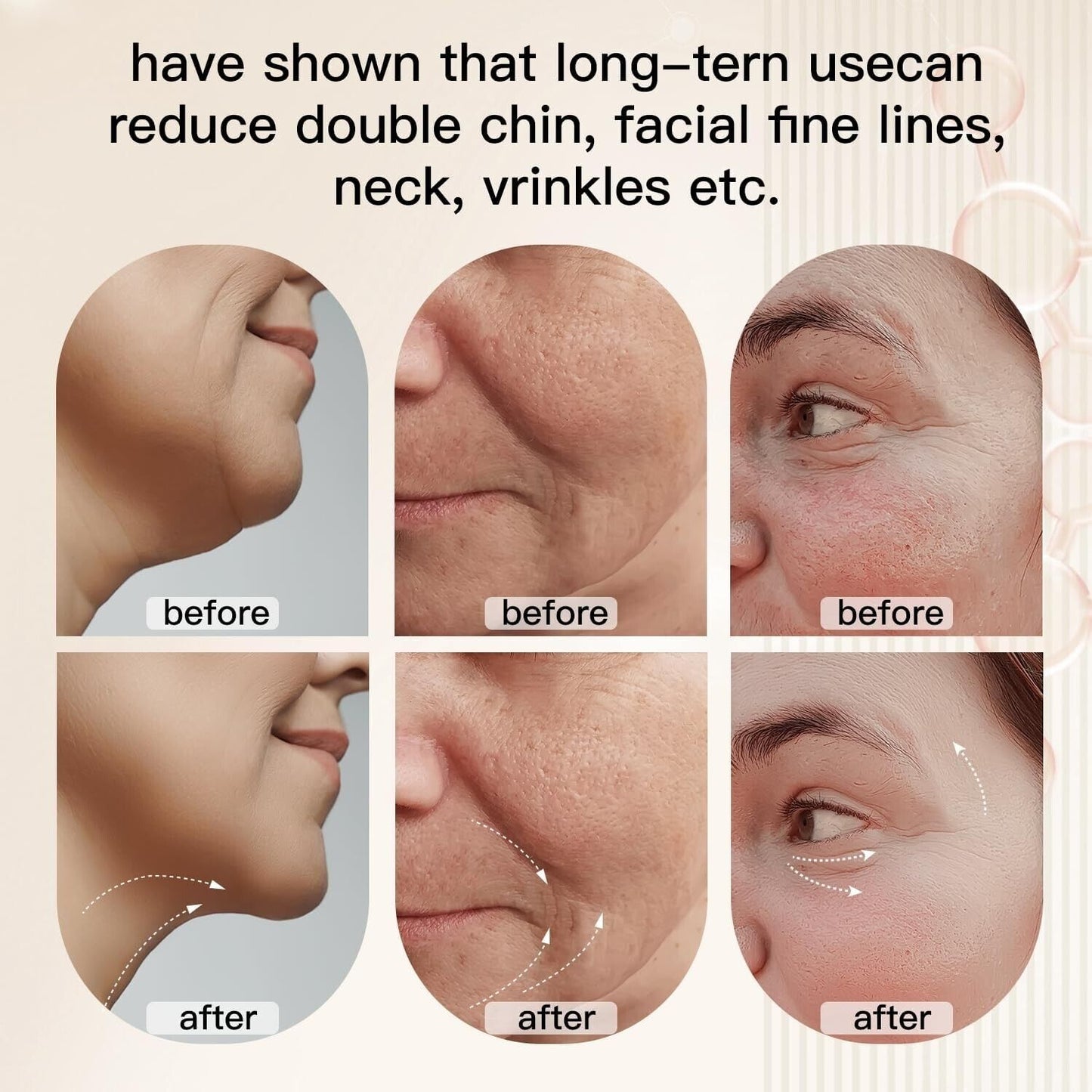 Before and after results showcasing the microcurrent face lift device's effectiveness on chin and wrinkles