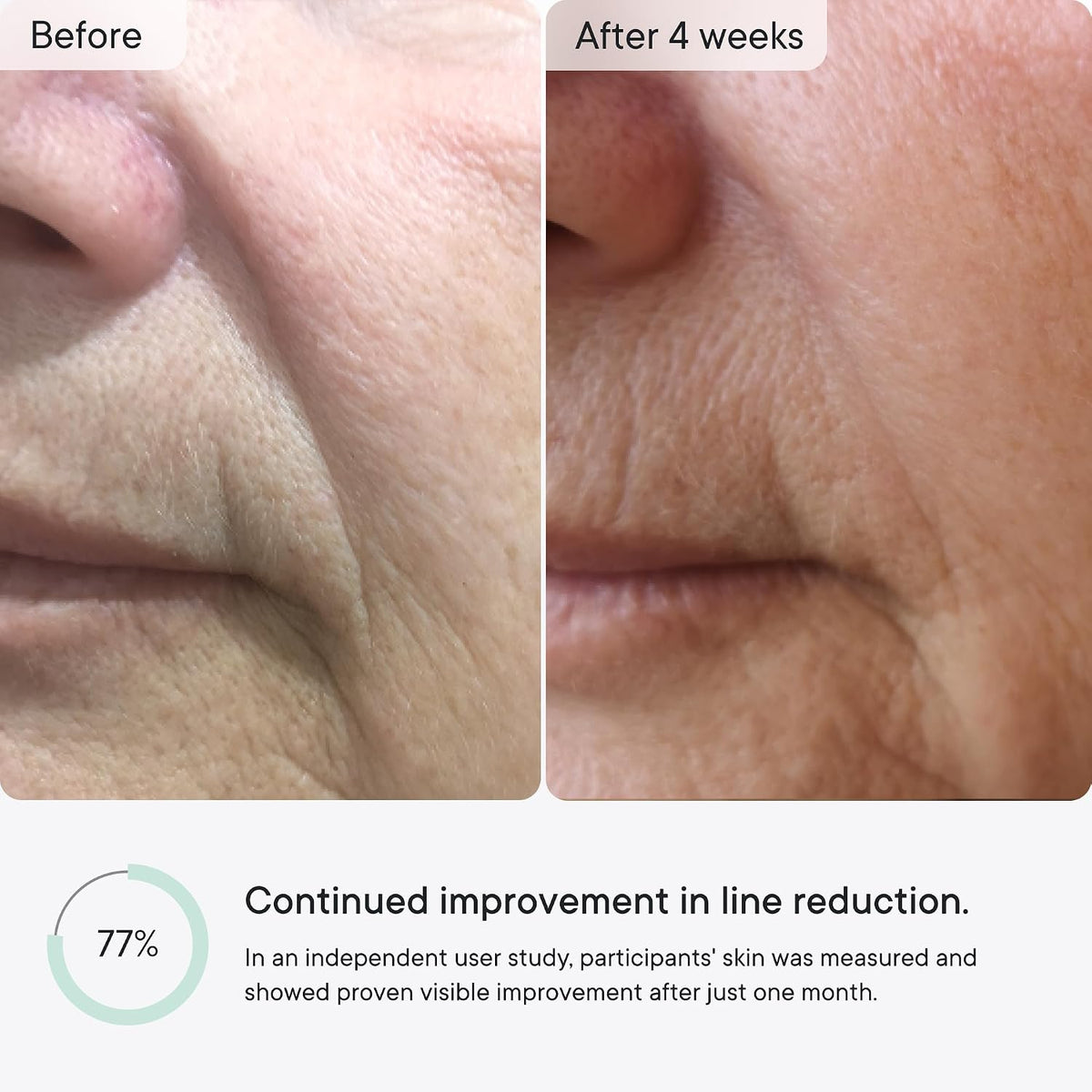 Qure Micro-Infusion Anti Wrinkle Patches for Smile Line, Frown lines, Under Eye Bags, Puffiness, Crow's Feet - Retinol, Caffeine - Dissolvable for Overnight Use - 8 Pairs