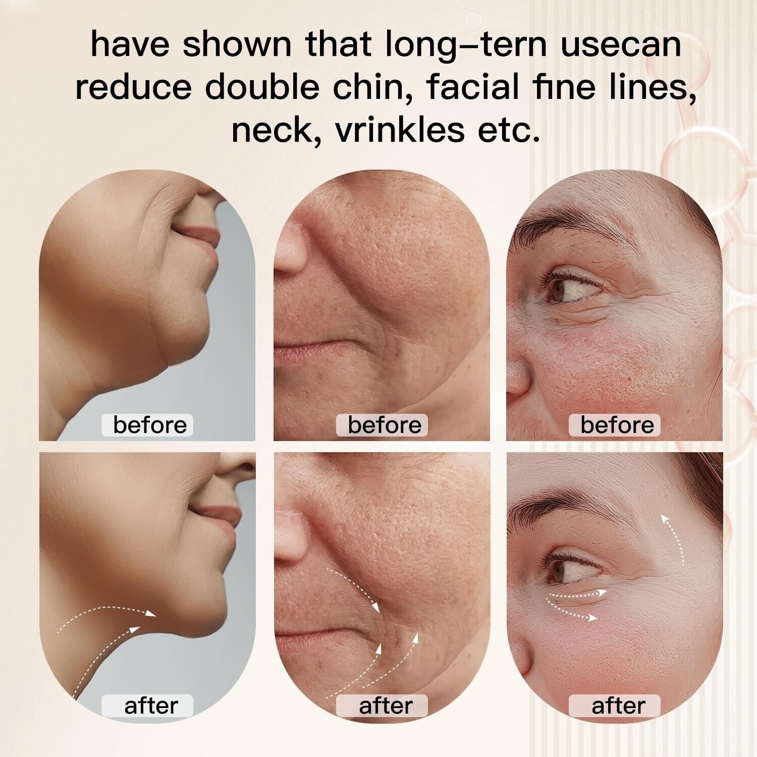 Before and after results showcasing the microcurrent face lift device's effectiveness on chin and wrinkles