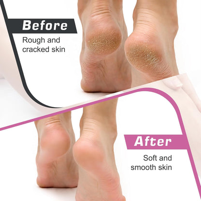 Before and after images of feet showing rough and cracked skin transformed using a professional pedicure tool with sandpaper discs
